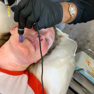 Microneedling Collagen Therapy Course