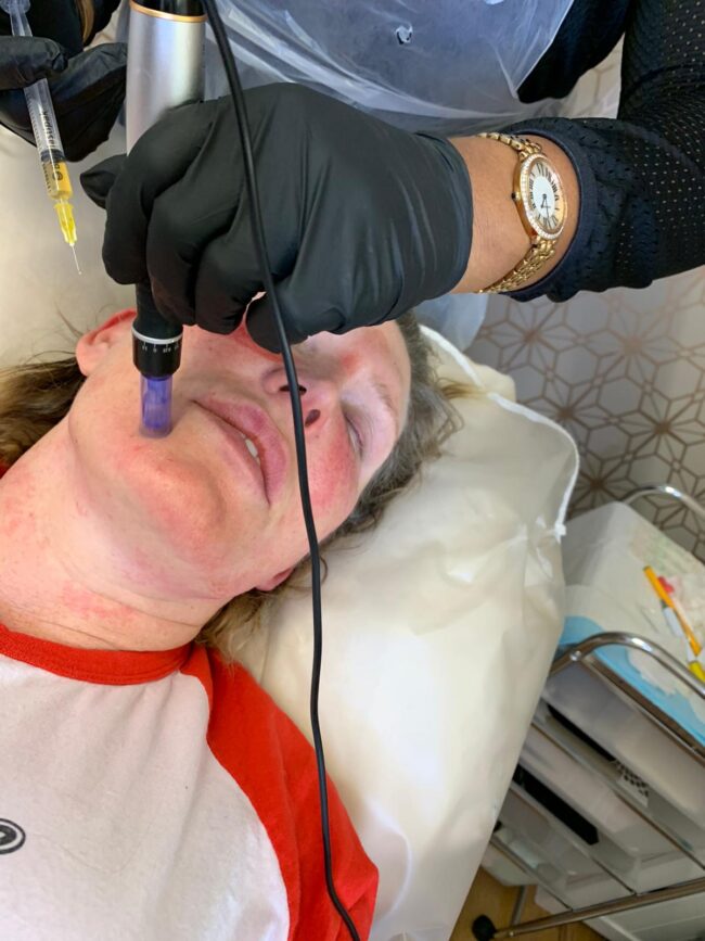 Microneedling Collagen Therapy Course