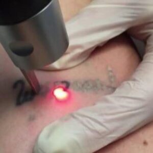 Tattoo removal Course