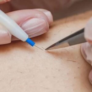 Electrical Epilation Electrolysis Course