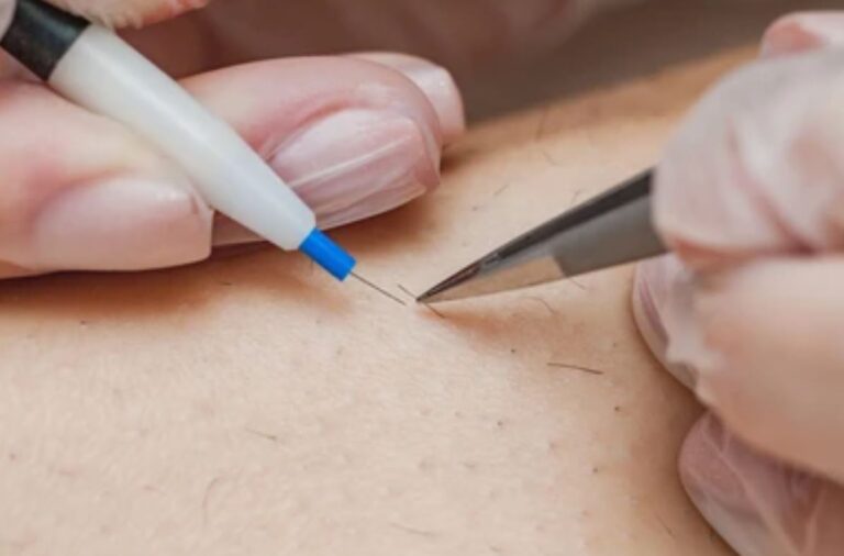 Electrical Epilation Electrolysis Course