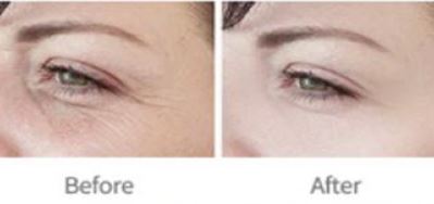 fusion plasma plasdual 14 warm cold hydurage aesthetics training courses machines devices lasers online beauty anti aging skin tightening