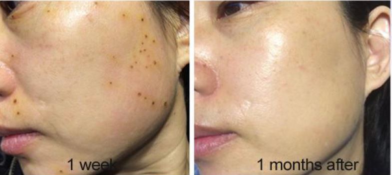 fusion plasma plasdual 14 warm cold hydurage aesthetics training courses machines devices lasers online beauty anti aging skin tightening