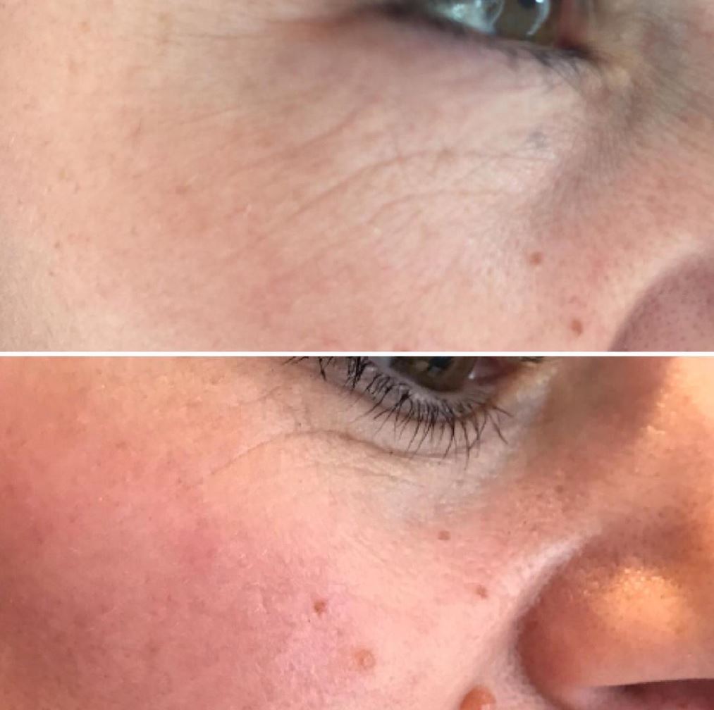 fusion plasma plasdual 14 warm cold hydurage aesthetics training courses machines devices lasers online beauty anti aging skin tightening
