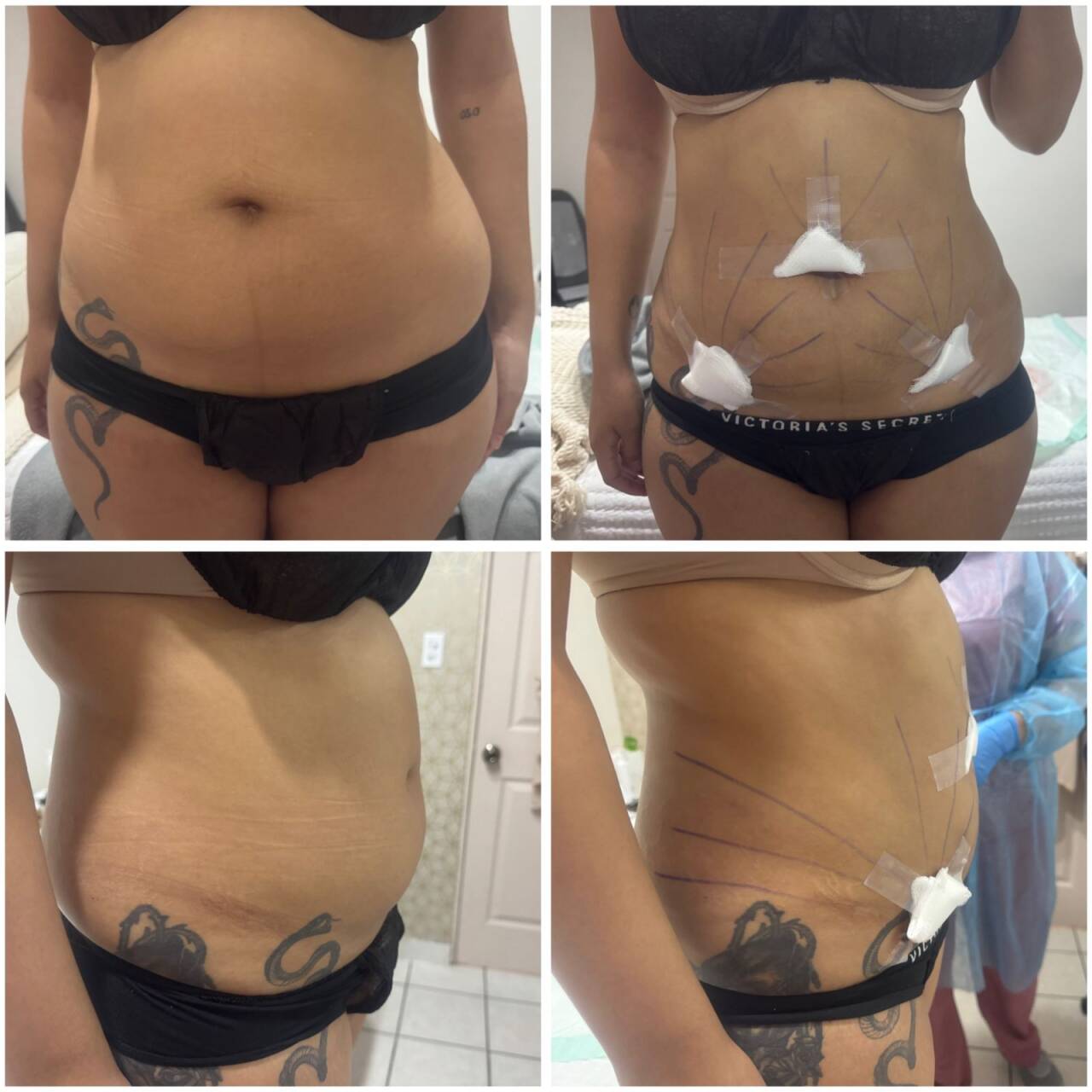 Endolifting Laser Device - ENDOLUMIX (tm) CEMDR