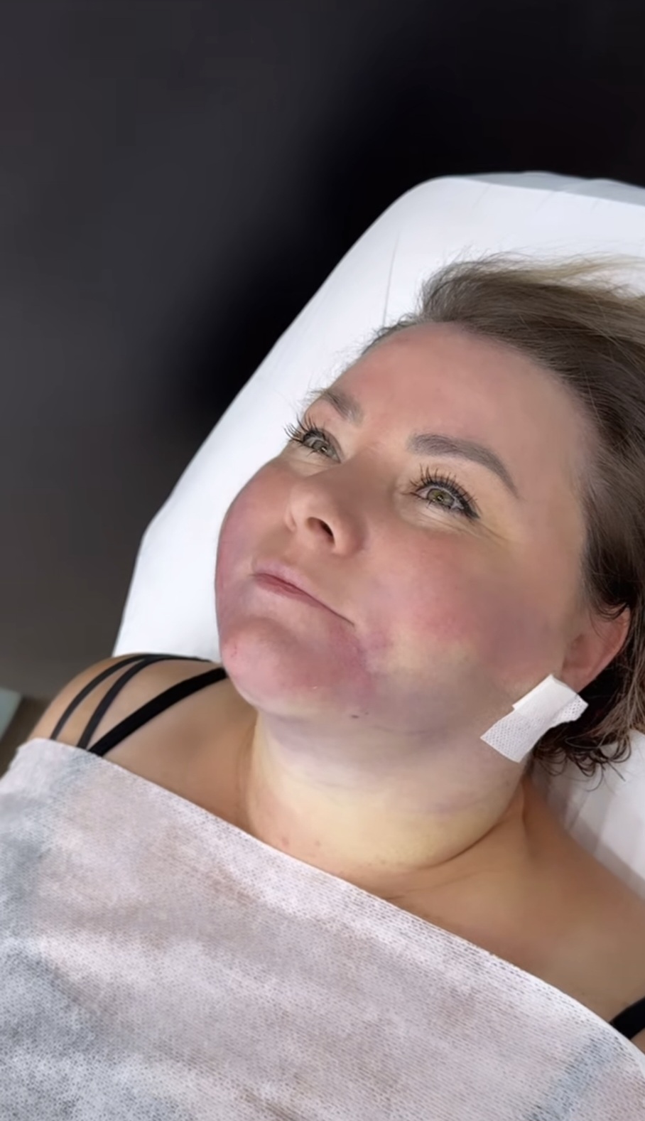 endolifting fibre laser hydurage FDA aesthetics training courses machines devices lasers online beauty anti aging skin tightening