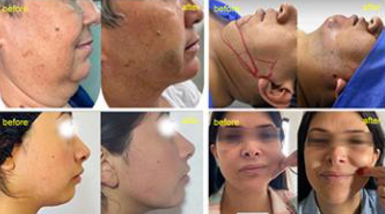 endolifting fibre laser hydurage FDA aesthetics training courses machines devices lasers online beauty anti aging skin tightening