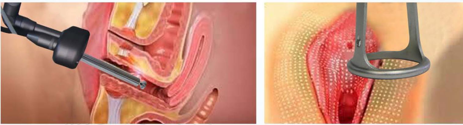 fractional CO2 laser multifunctional hydurage aesthetics training courses machines devices lasers online beauty anti aging skin tightening