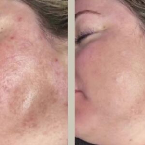 cold training hydurage aesthetics training courses machines devices lasers online beauty anti aging skin tightening