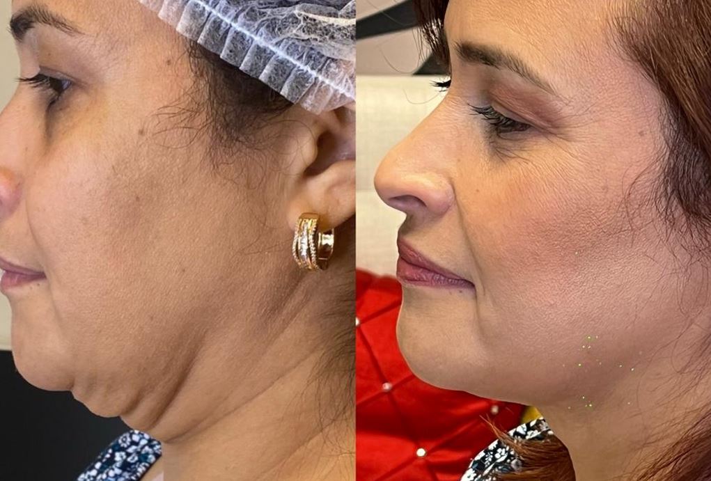 endolifting fibre laser hydurage FDA aesthetics training courses machines devices lasers online beauty anti aging skin tightening