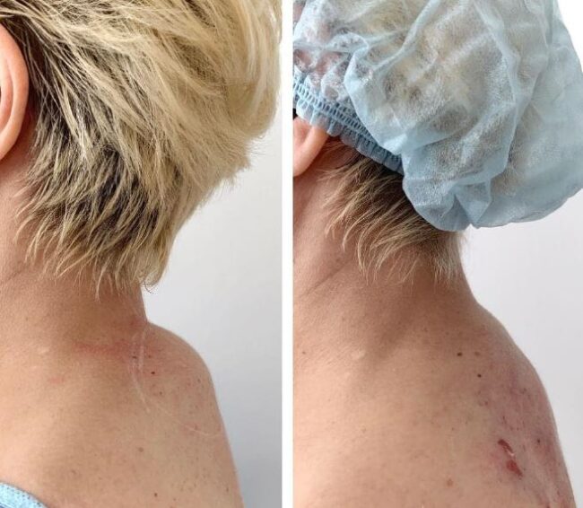 endolifting fibre laser hydurage FDA aesthetics training courses machines devices lasers online beauty anti aging skin tightening