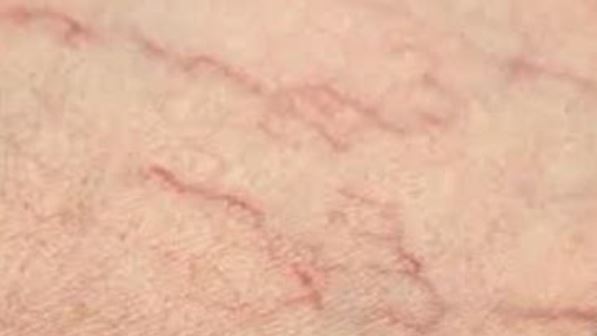 Hydurage Sclerotherapy machine device aesthetics online training courses plaxpot skincare skin tightening rejuvenation