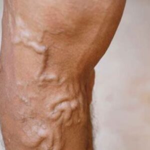 Hydurage Sclerotherapy machine device aesthetics online training courses plaxpot skincare skin tightening rejuvenation