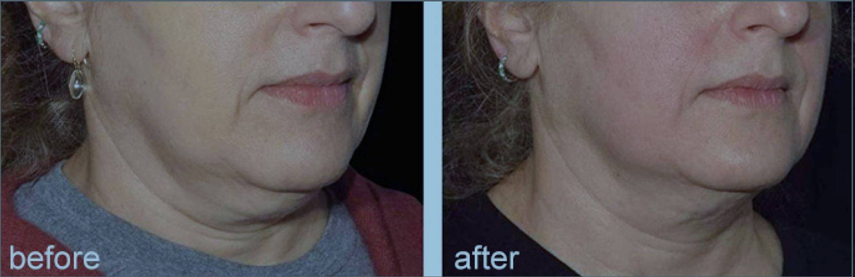 EMS facial machine hydurage aesthetics training courses machines devices lasers online beauty anti aging skin tightening