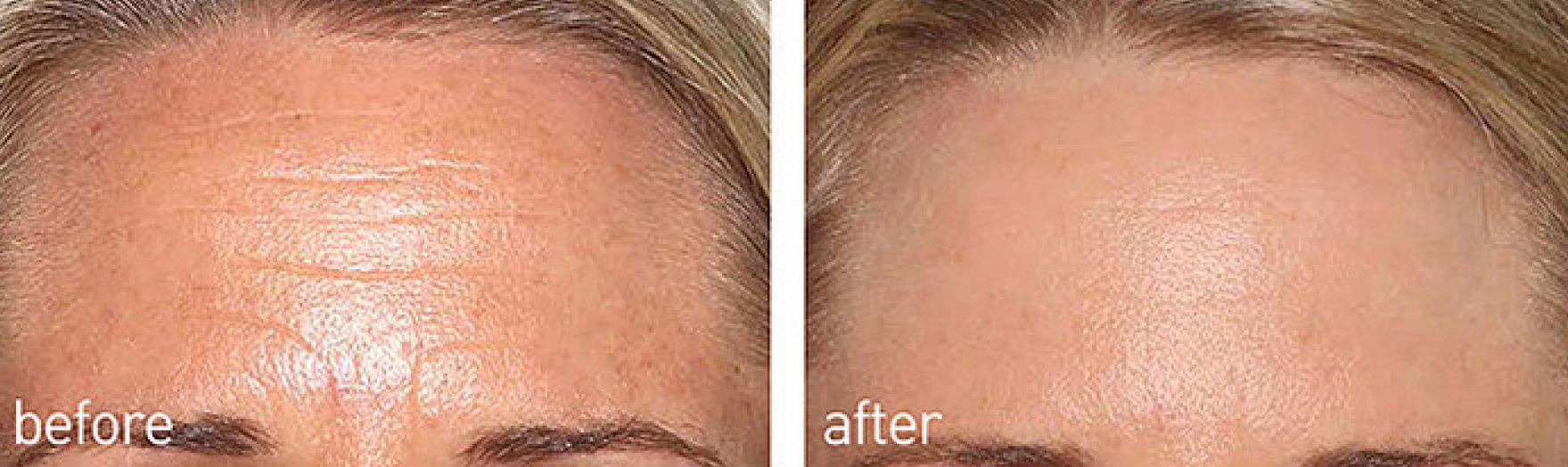 EMS facial machine hydurage aesthetics training courses machines devices lasers online beauty anti aging skin tightening