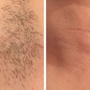 1800 wavelength diode laser hydurage aesthetics training courses machines devices lasers online beauty anti aging skin tightening