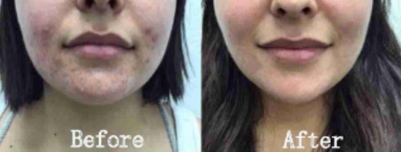 RF microneedling morejuve 8 hydurage aesthetics training courses machines devices lasers online beauty anti aging skin tightening