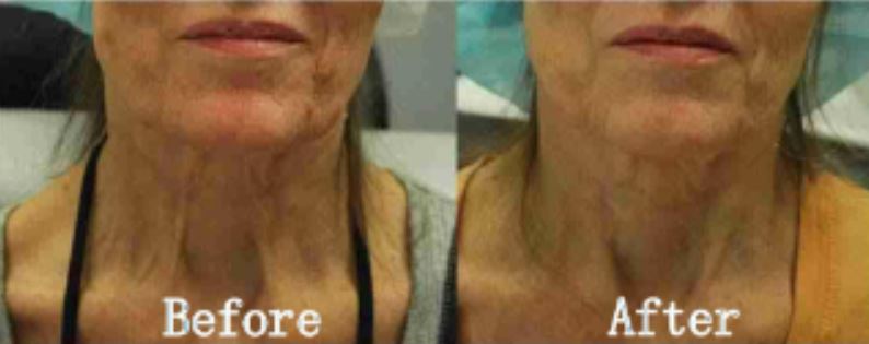 RF microneedling morejuve 8 hydurage aesthetics training courses machines devices lasers online beauty anti aging skin tightening