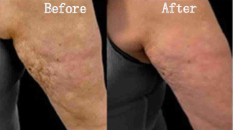 RF microneedling morejuve 8 hydurage aesthetics training courses machines devices lasers online beauty anti aging skin tightening