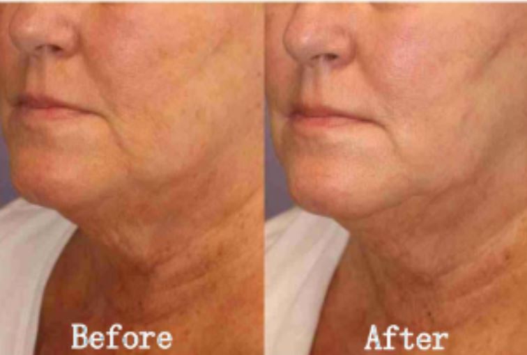 RF microneedling morejuve 8 hydurage aesthetics training courses machines devices lasers online beauty anti aging skin tightening