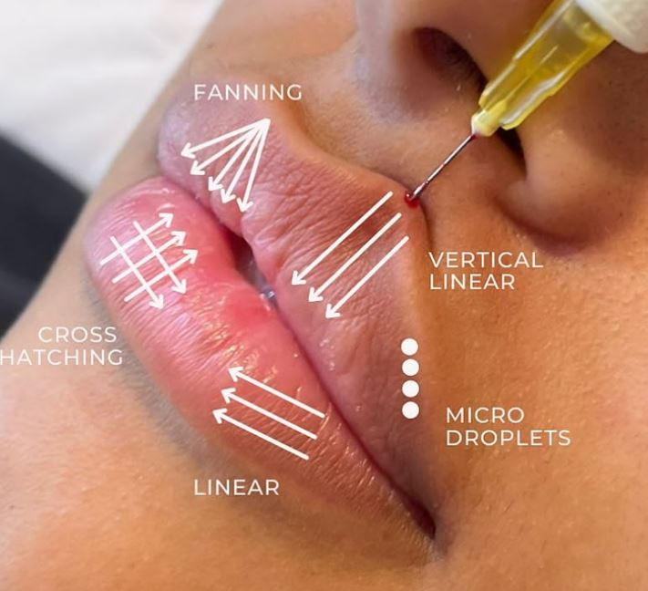 hydurage advanced dermal fillers russian lips aesthetics training courses machines devices lasers online beauty anti aging skin tightening