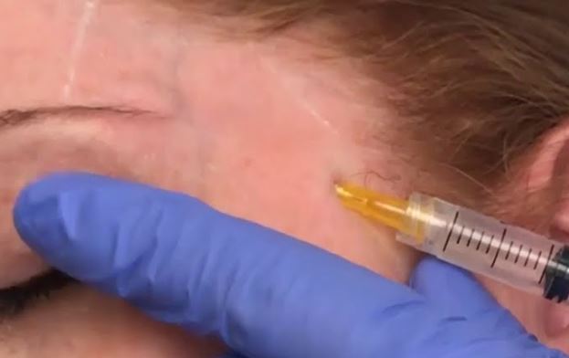 advanced dermal fillers hydurage aesthetics training courses machines devices lasers online beauty anti aging skin tightening