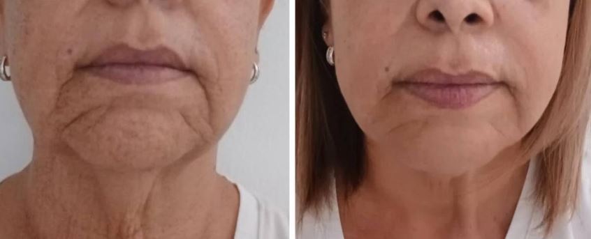 cold plasma plasdual hydurage FDA aesthetics training courses machines devices lasers online beauty anti aging skin tightening