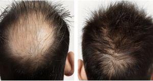 hair loss treatment 1565nm laser