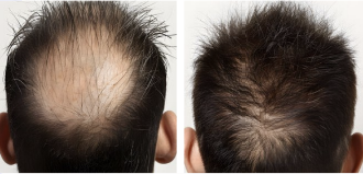 hair loss treatment 1565nm laser