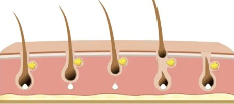 Read more about the article Diode Laser Hair Removal Course