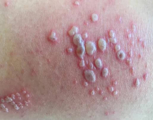 used in laser hair removal course