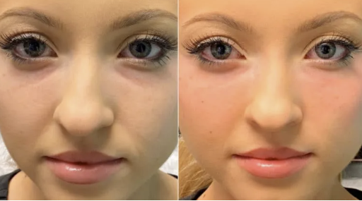 used in advanced dermal filler