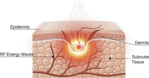 used in microneedling course