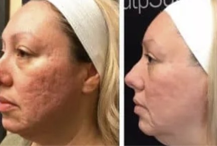 used in rf microneedling course